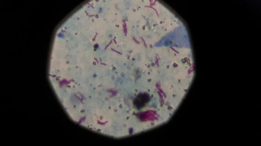 আশঙ্কাজনক হারে বাড়ছে যক্ষ্মা সংক্রমণ, বিশেষ সতর্কতা জারি